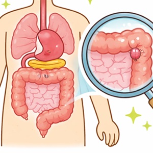 『大腸ポリープ』ができやすい人の特徴